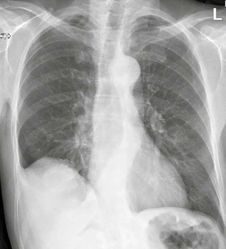 RTG plic s nálezem ostře ohraničeného stínu v dolním
plicním poli vpravo<br>
Fig. 1: Chest radiograph showing lobulated mass in the
lower zone of the right hemithorax
