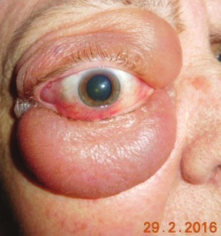 Typical image of infiltration of soft tissues of orbit upon lymphoma disease