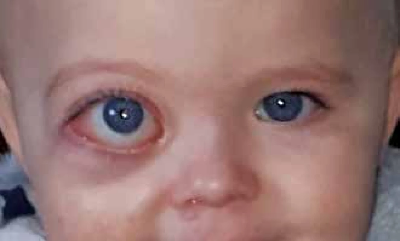 Protruze pravého bulbu s asymetrií obličeje.
Fotografie pořízená ve 14. měsíci věku