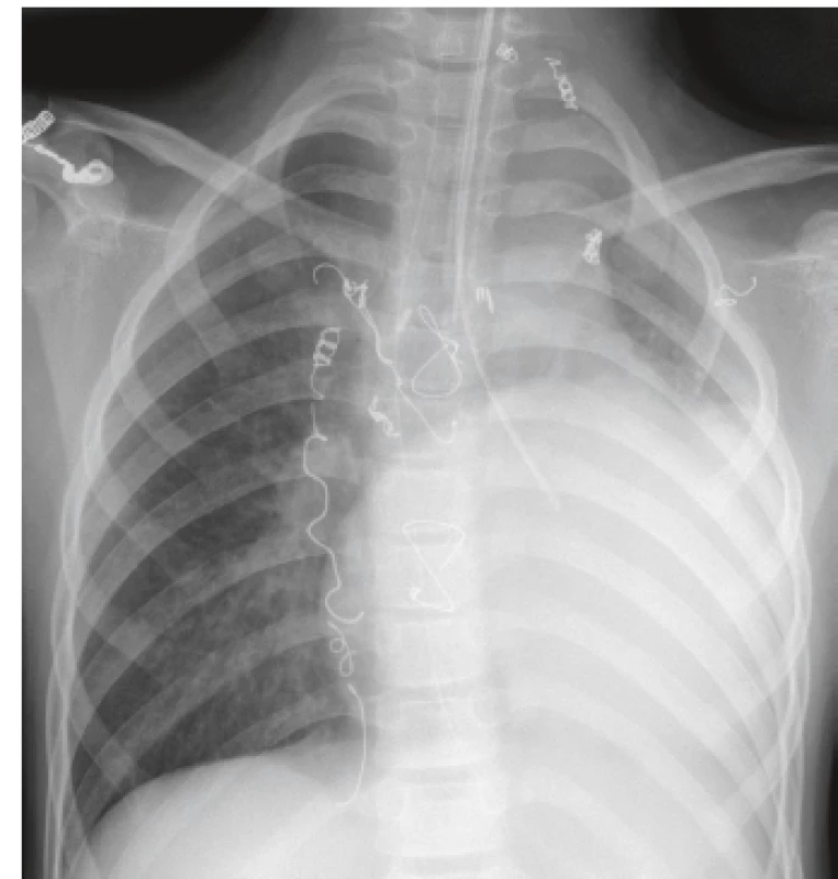 RTG snímka hrudníka zobrazuje obturátor zavedený
do ľavej priedušky (pacient 2).<br>
Fig. 2. Chest X-ray shows endobronchial balloon blocker in
the left bronchus (patient 2).