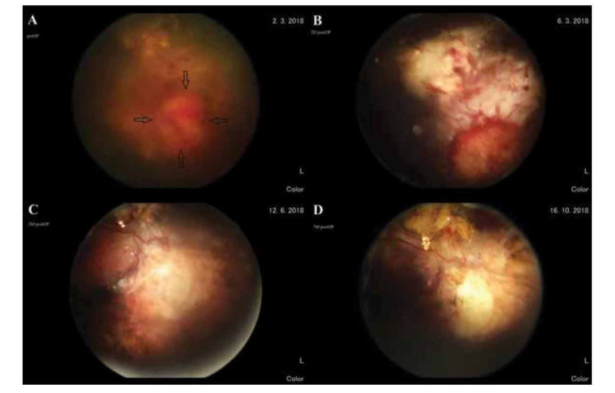 Dolná temporálna periféria sietnice. (A) pred operáciou – tumor (čierne šípky), (B) 2 dni po operácii (okraje
retinektómie ošetrené endolaserom a kryoretinopexiou), (C) 3 mesiace po operácii, (D) 7 mesiacov po operácii