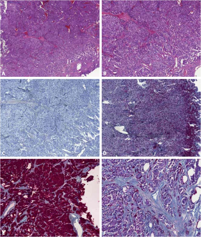 Paragangliom močového měchýře tvořící tzv. typické „Zellballen“ (A) (B). Nádor je negativní v průkazu cytokeratinu CK7 (C), přítomna je jaderná exprese v GATA3 (D) a typická pozitivita nádorových buněk v chromograninu A (E). Na periferii „Zellballen“ a rozptýlené mezi polygonálními chromafinními nádorovými buňkami jsou tzv. Sustentakulární buňky, které jsou pozitivní v imunohistochemickém průkazu S100 (F).