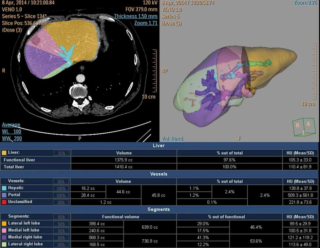 CT volumetrie po portální venózní embolizaci (hypertrofický levý lalok s jizvou po radiofrekvenční ablaci).<br>
Fig. 2. CT volumetry following portal venous embolisation (hypertrophic left lobe after radiofrequency ablation).