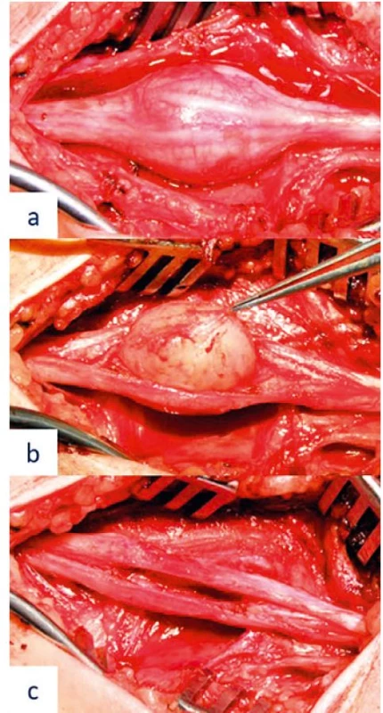 Peroperative image of the median nerve schwannoma resection –
(a) fascicle course on the surface of the tumour preceding tumour resection,
(b) microsurgical tumour resection, and (c) preserved neural structures following
radical tumour resection