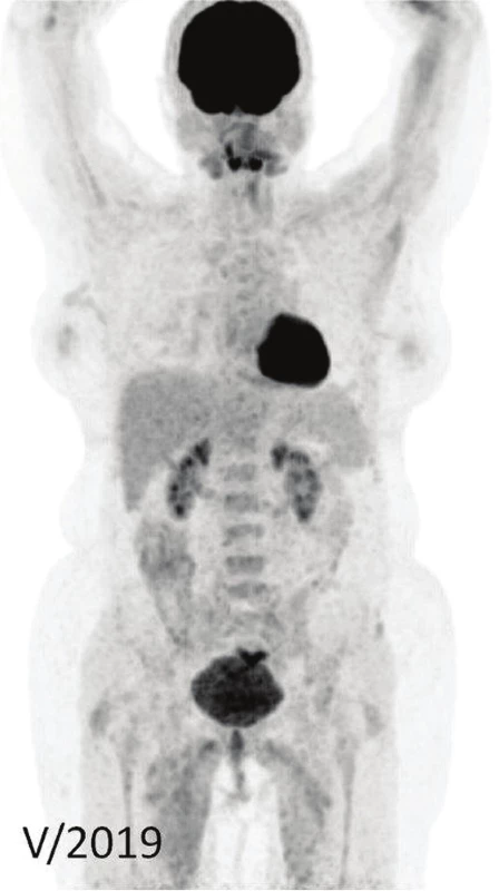 <sup>18</sup>F-FDG PET/CT – MIP, negativní nález – bez
známek aktivity onemocnění.