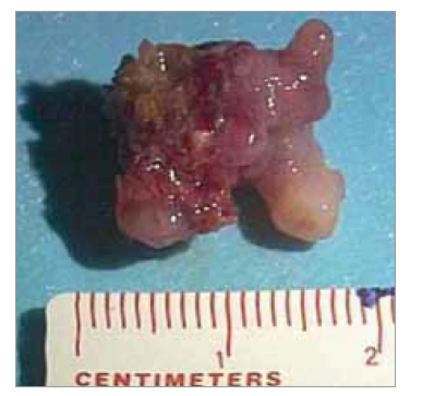 Makroskopický vzhled a velikost
choristomu po extrakci.<br>
Fig. 3. Macroscopic appearance and
size of the choristoma after extraction.