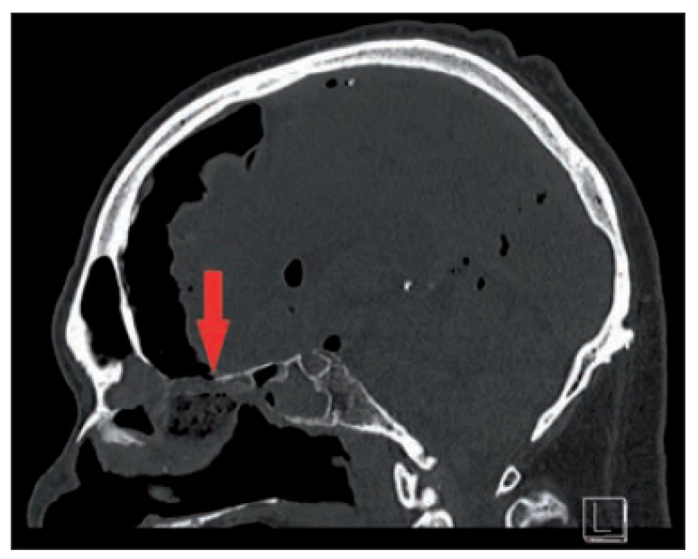 Preoperative CT, the arrow shows
the defect and resulting pneumocephalus.<br>
Obr. 1. Předoperační CT, šipka ukazuje
defekt a následně vzniklý pneumocefalus.