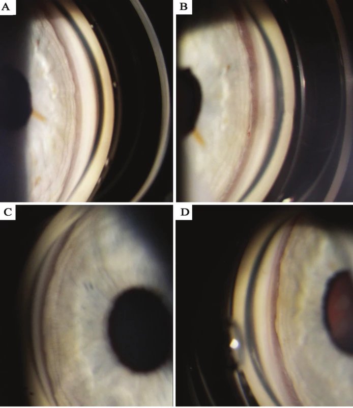 Gonioscophy photograph – documentation of configuration of chamber angle, A) right eye before discontinuation of trazodone, B)
right eye after discontinuation of trazodone, C) left eye before discontinuation of trazodone, D) left eye after discontinuation of trazodone.