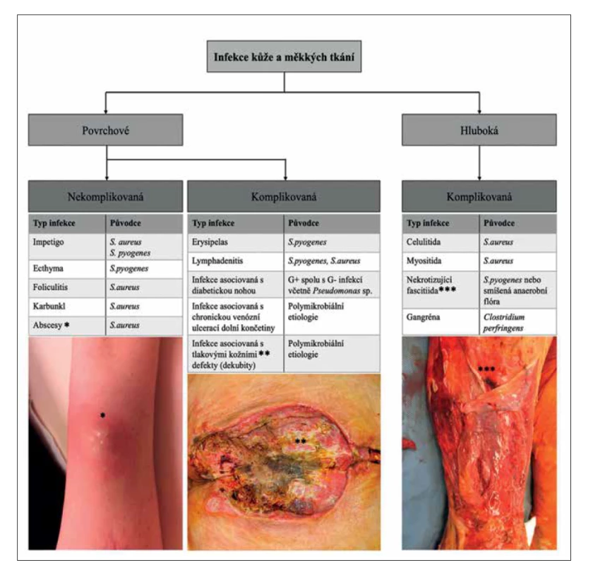 Klasifikace infekcí kůže a měkkých tkání [7]<br>
(foto archiv autorů)<br>
Figure 1. Classification of skin and soft tissue infections [7]<br>
(photo: authors’ archive)
