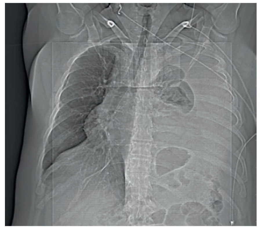 Iniciálny RTG obraz s pretlakom mediastinálnych
štruktúr doprava<br>
Fig. 1. Initial chest X-ray with mediastinal shift to the right