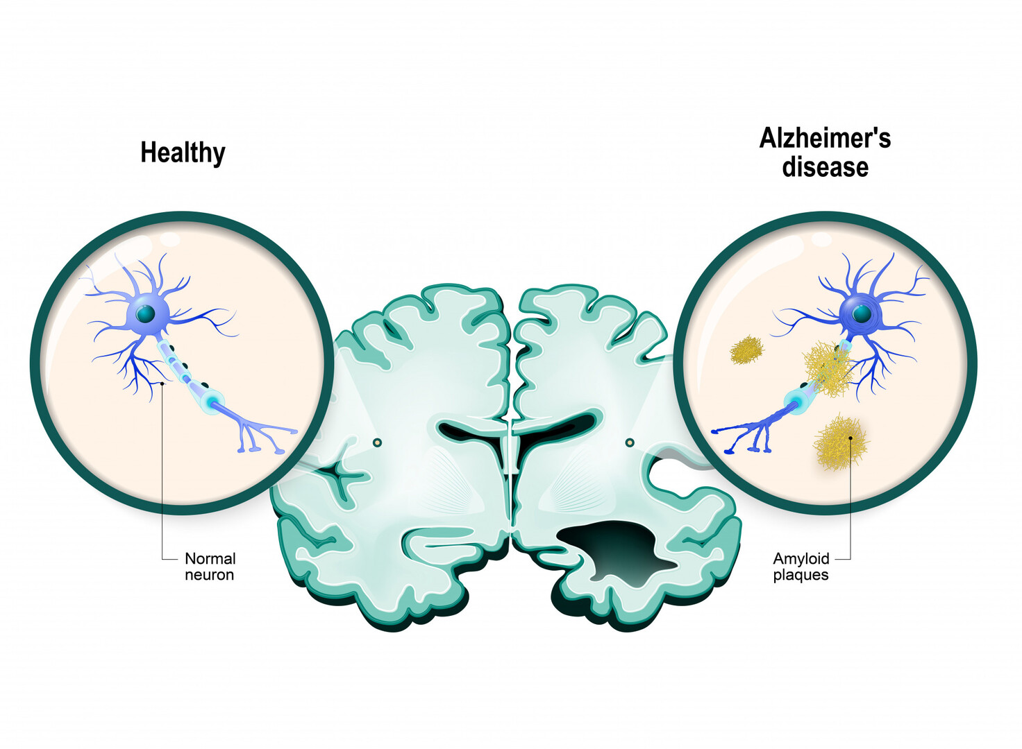 alzheimer 12