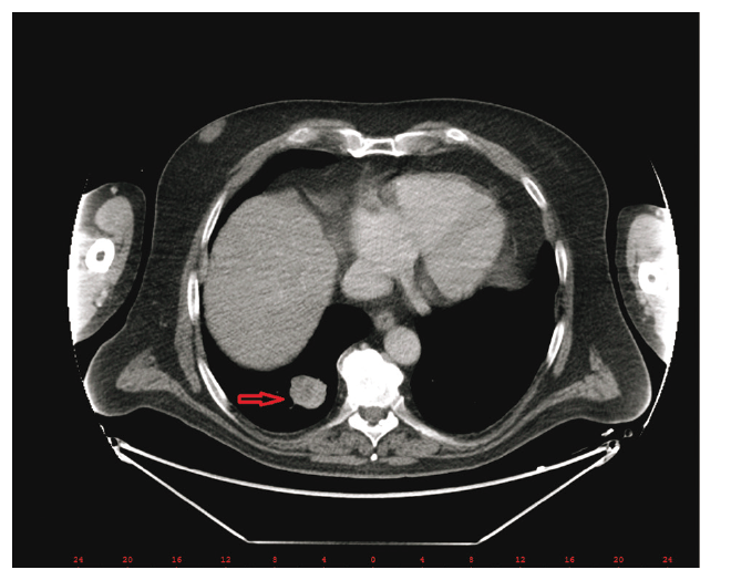 Plicní metastáza před terapií ipilimumabem –
PET/CT (zdroj: Ústav nukleární medicíny VFN)
