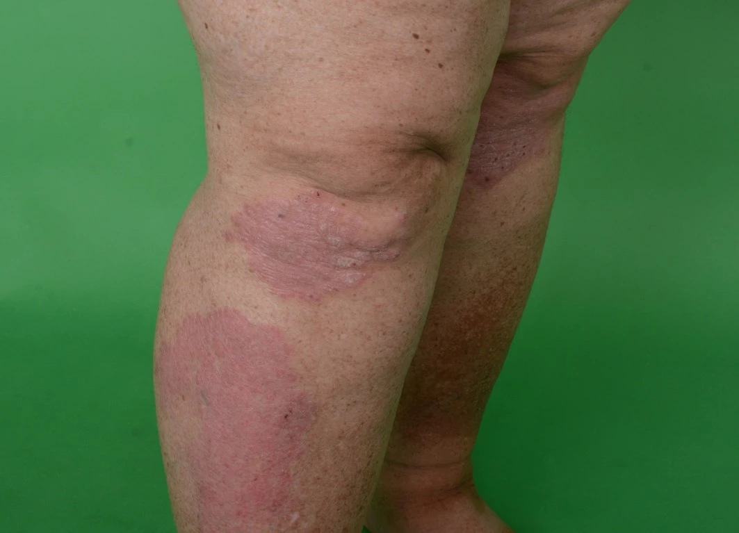 Rychlý a dlouhodobě přetrvávající výborný efekt bimekizumabu u pacientky s těžkou psoriázou a psoriatickou artritidou – kazuistika