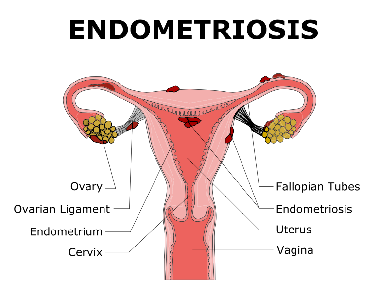 Endometriosis2