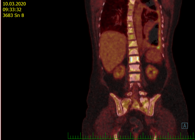 PET/CT 4. března 2016 při progresi před zahájením léčby krizotinibem