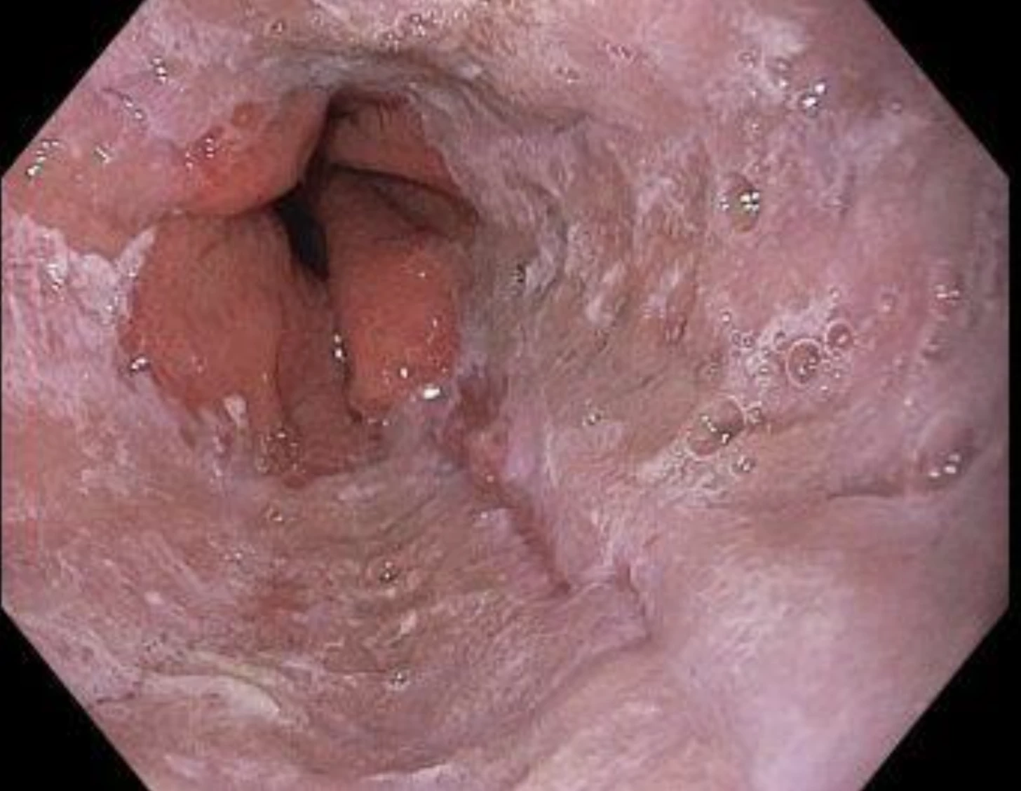 Bolest v krku jako projev gastroezofageálního refluxu – kazuistika