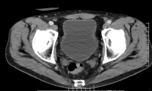 Obrázek  6  CT břicha, pánve - květen 2018 -  po devíti měsících léčby. Tumor sigmoidea v kompletní regresi.