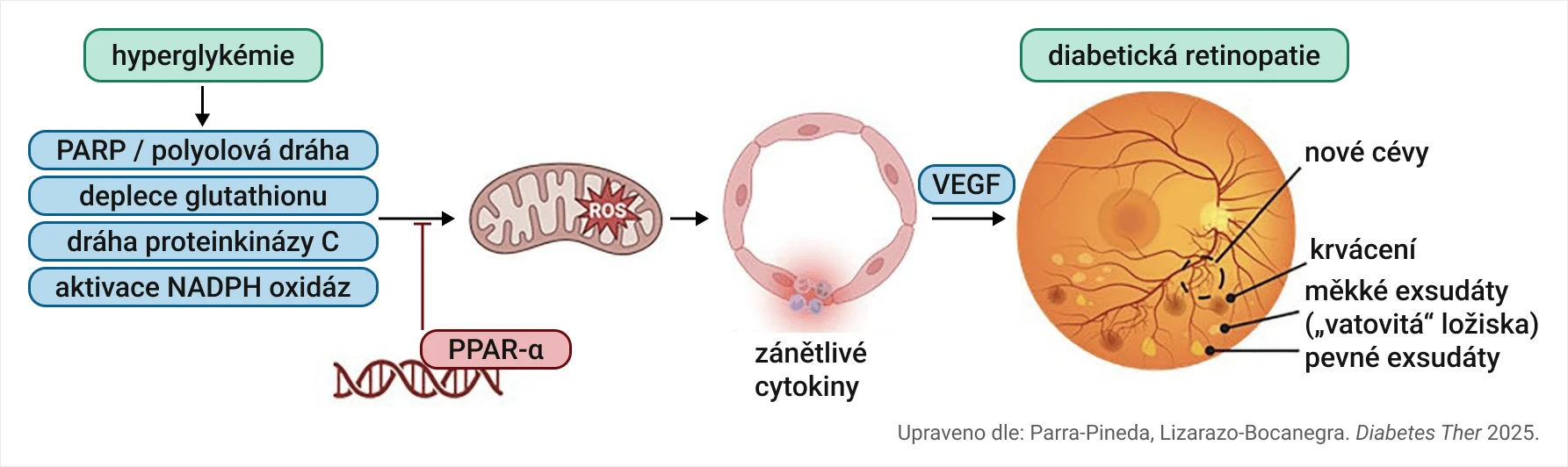 Patofyziologie diabetické retinopatie pod lupou: od hyperglykémie ke změnám na sítnici