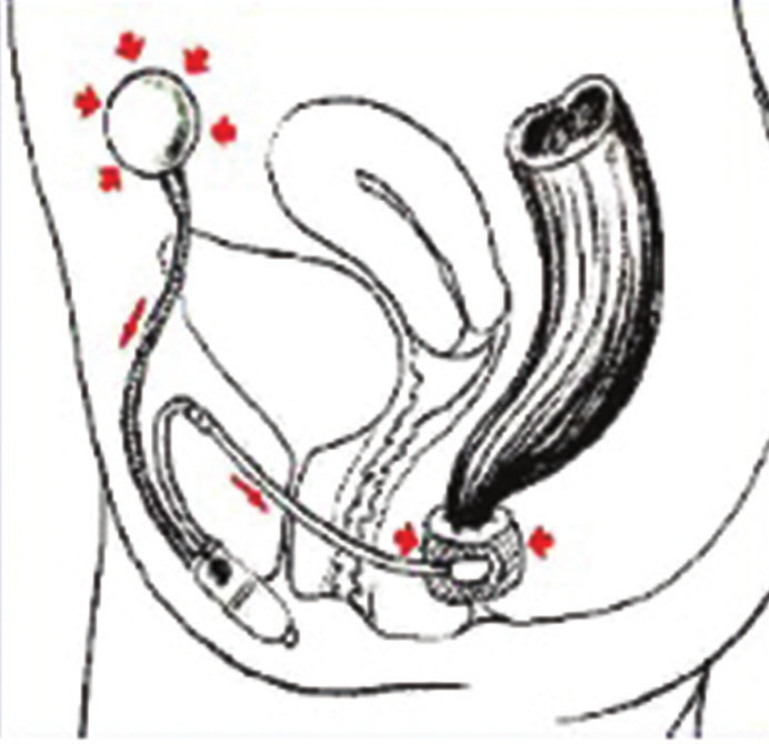 Obr. 2. Umělý svěrač anu Acticon Neosphincter – schematické znázornění umístění a funkce Fig. 2: Artificial anal sphincter Acticon Neosphincter – placement and function