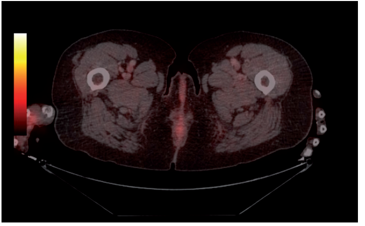PET/CT vyšetření s FDG avidním ložiskem pravého
předloktí 01/2017