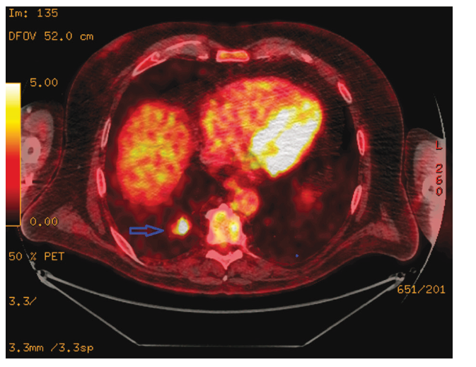Plicní metastáza před terapií nivolumabem –
PET/CT (zdroj: Ústav nukleární medicíny VFN)