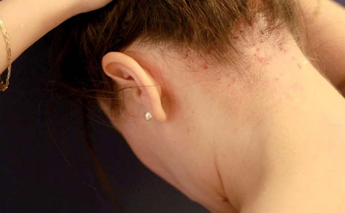 Obr. 3. Atopická dermatitida ve kštici. Fig. 3. Atopic dermatitis on scalp.