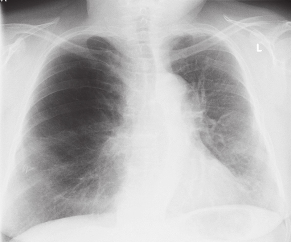 Obr. 1. RTG po primotransplantaci Fig. 1. Chest X-ray after primary transplantation