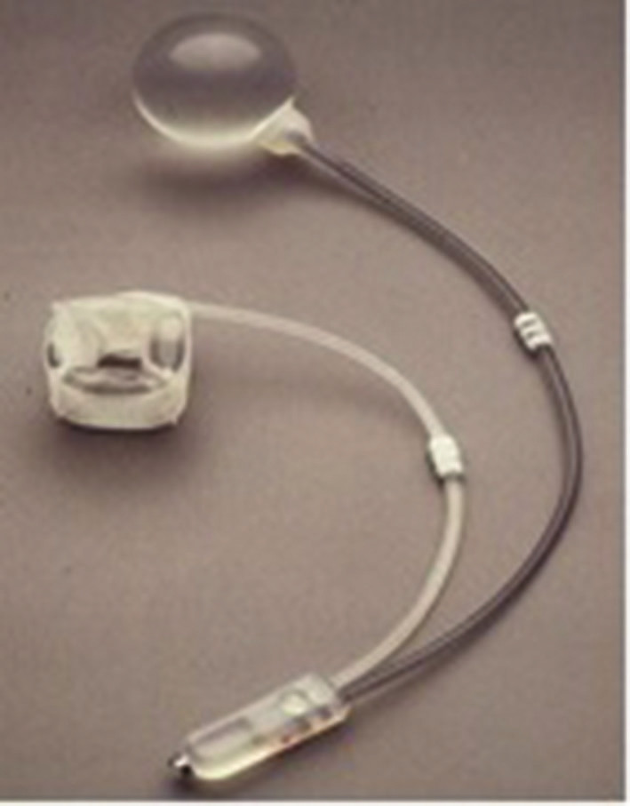 Obr. 1. Umělý svěrač anu Acticon Neosphincter – pomůcka Fig. 1: Artificial anal sphincter Acticon Neosphincter – the device
