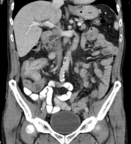 Obrázek  1  CT břicha, pánve - srpen 2017  Nádorový infiltrát v oblasti céka a terminálního ilea, zmnožené lymfatické uzliny v retroperitoneu aortokaválně.