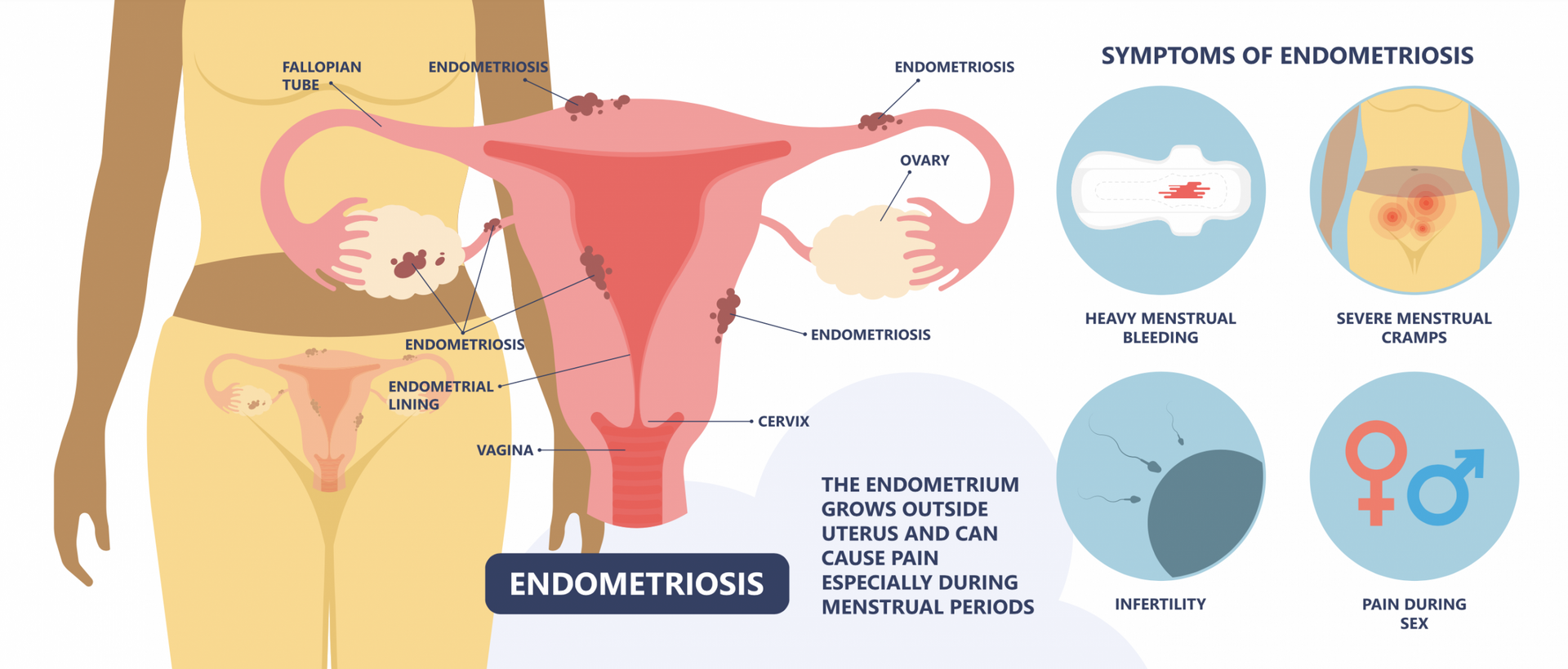 Endometriosis