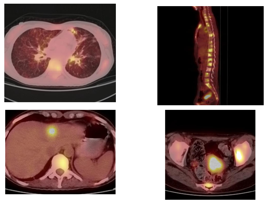 PET/CT 10. března 2020 při léčbě lorlatinibem