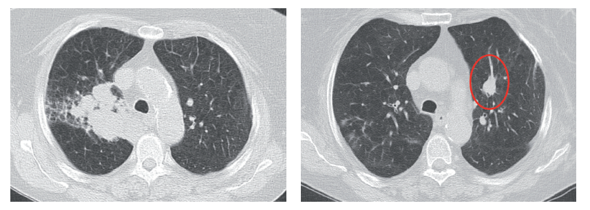 CT skeny s progredující
tumorozní infiltrací vpravo
a metastázou v levé plíci po
chemoterapii před zahájením
nivolumabu