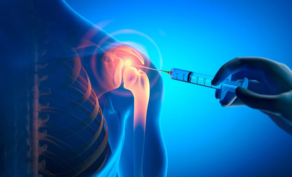 Romosozumab vs. teriparatid − přímé porovnání osteoanabolické léčby postmenopauzální osteoporózy
