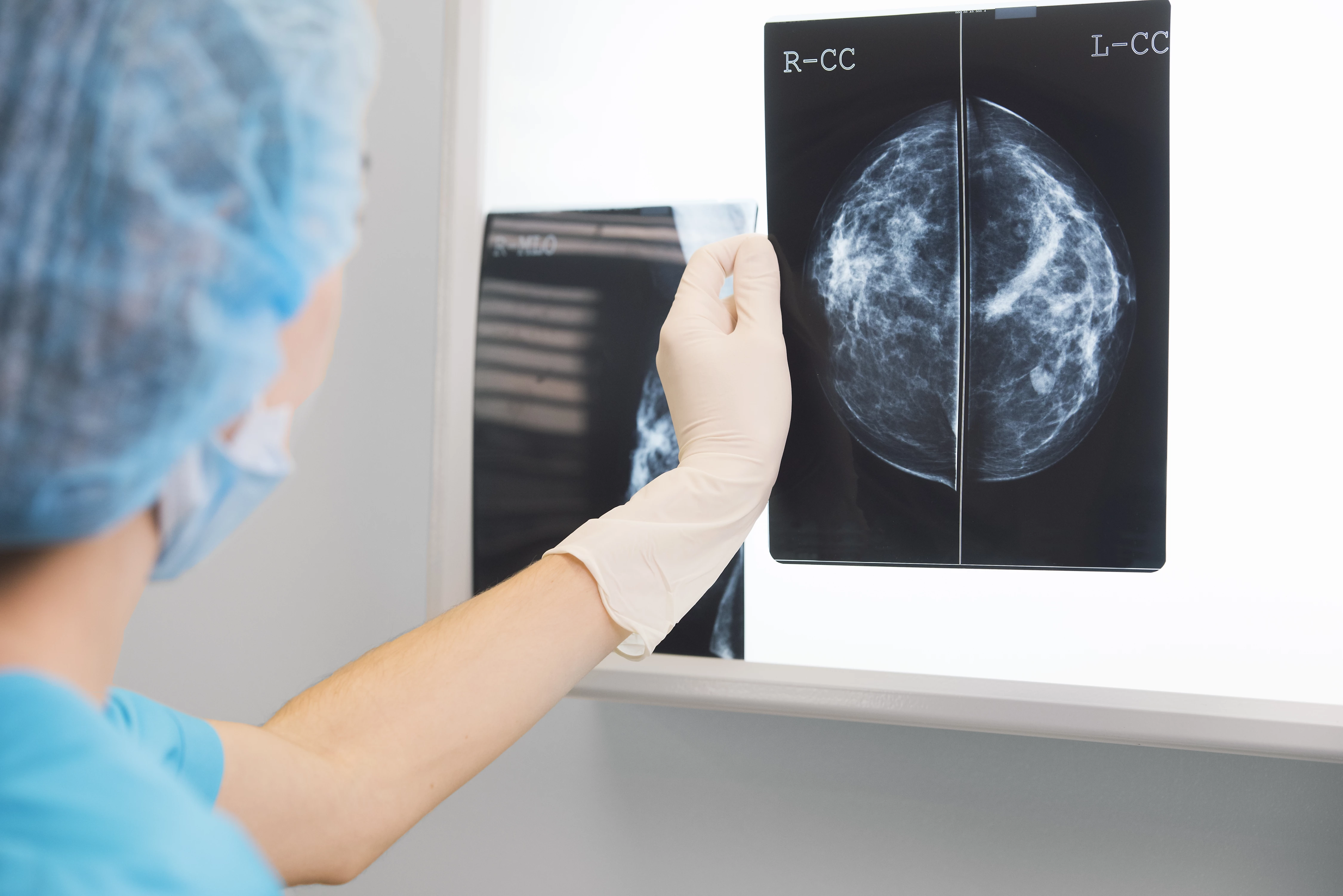Umělá inteligence v detekci karcinomu prsu – výsledky z reálné klinické praxe