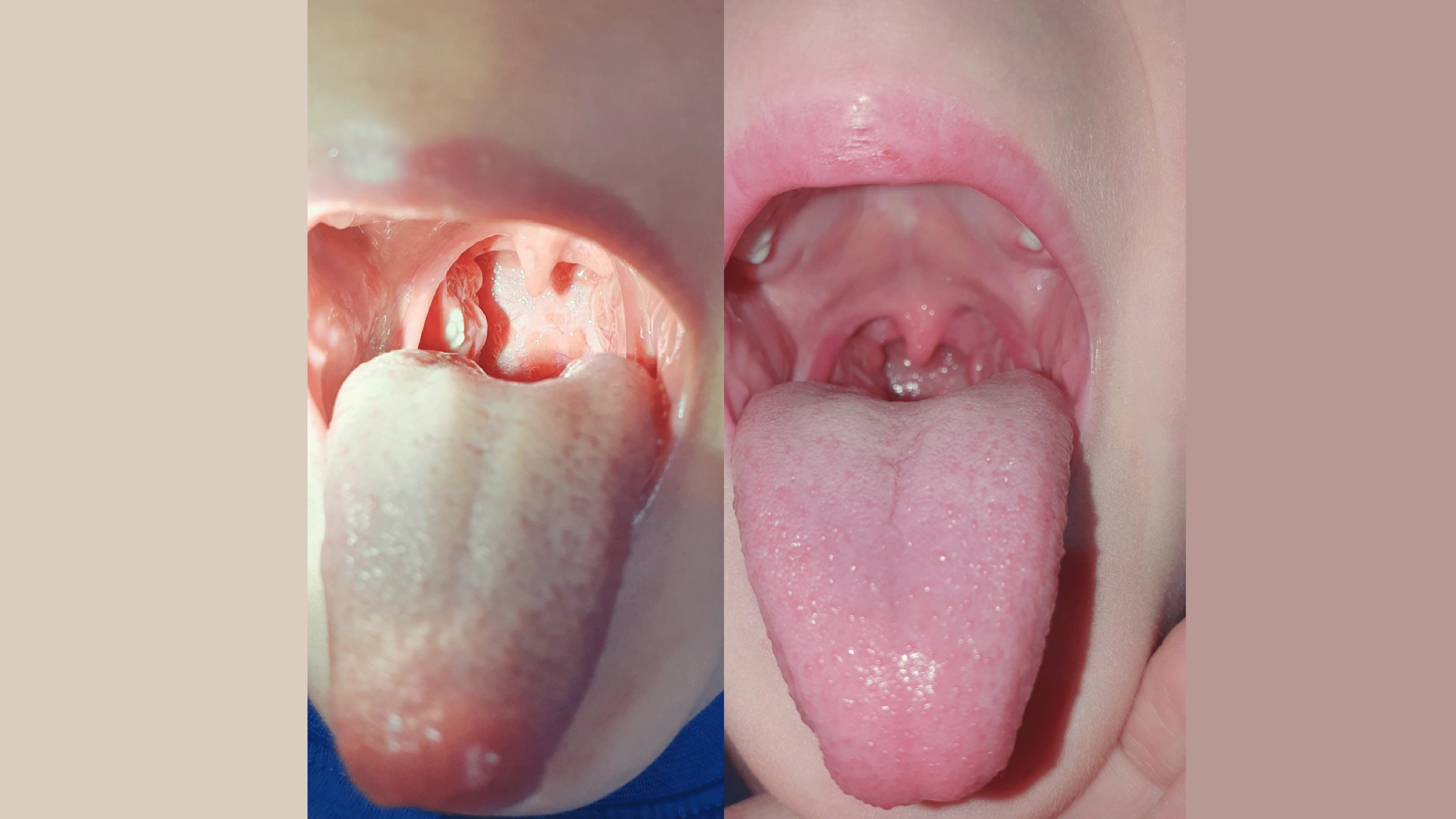 Podpůrné podávání doplňku stravy BioGaia Pharax při léčbě recidivujících infekcí HCD či faryngitid u dětí – soubor krátkých kazuistik