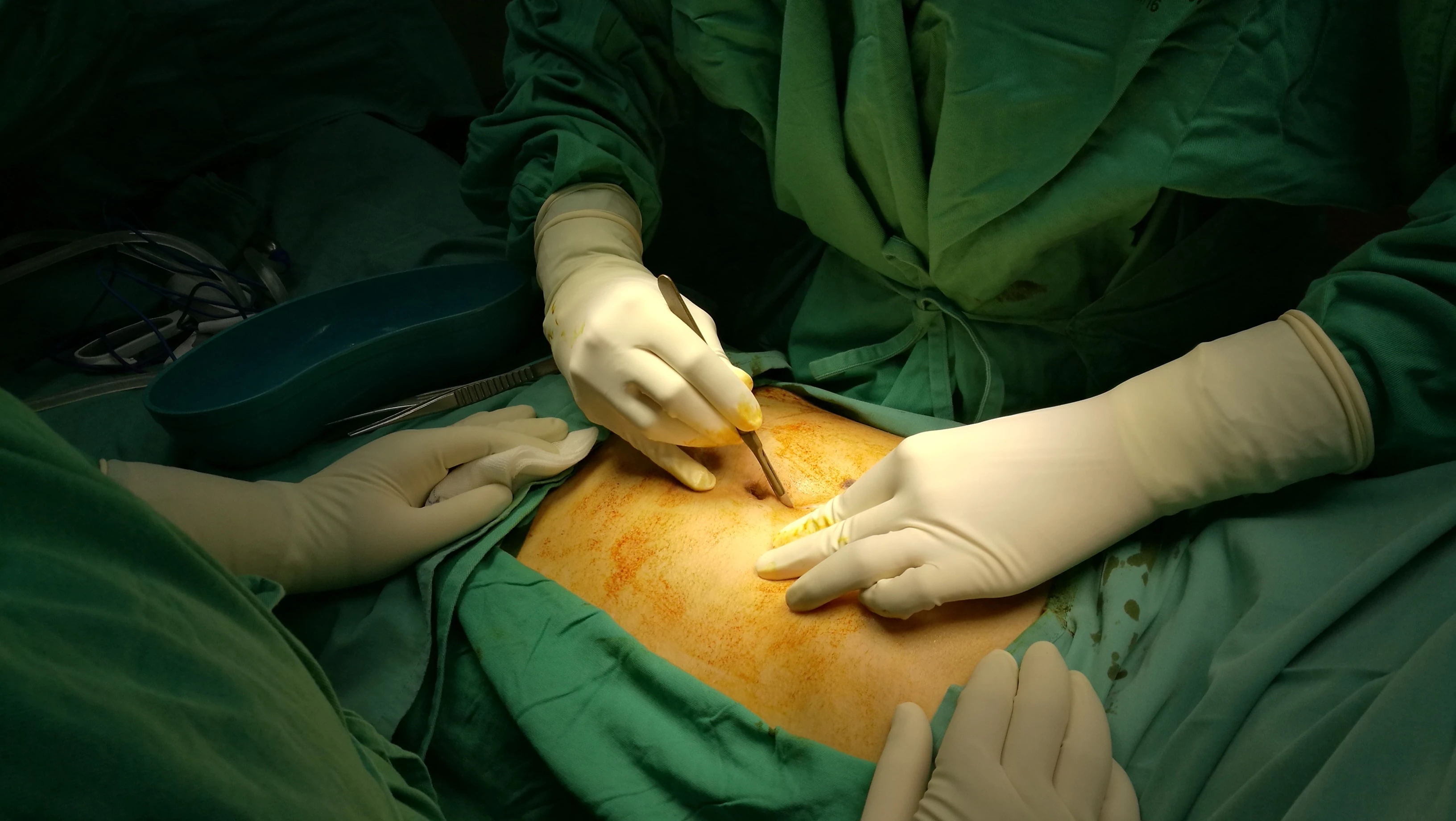 Open abdomen
