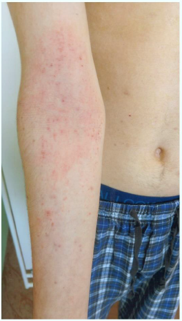 Stav při návštěvě dermatologa − exacerbace po nástupu na střední školu