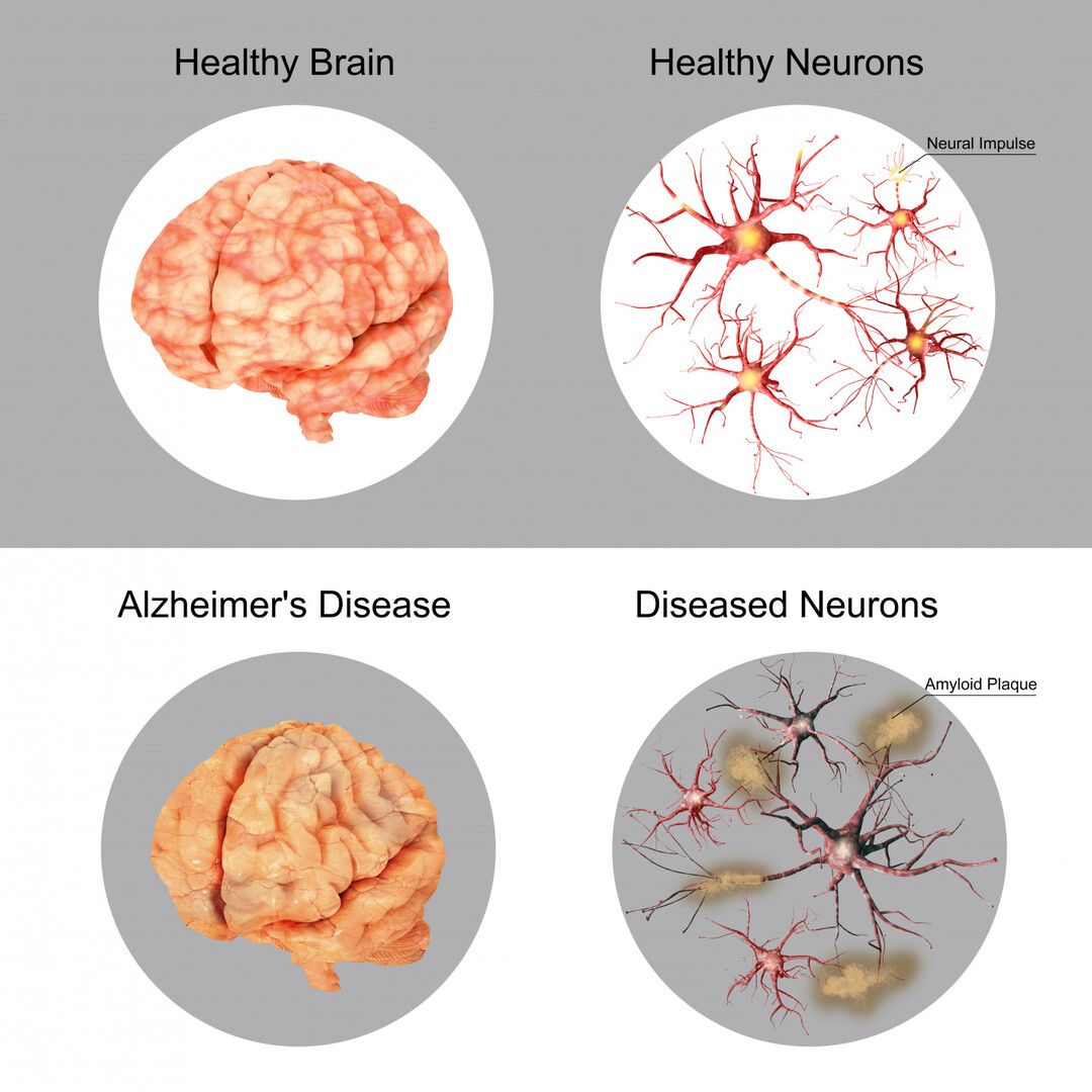 alzheimer 16