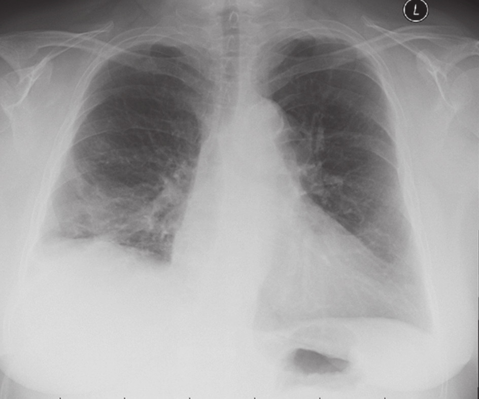 Obr. 2. RTG po retransplantaci Fig. 2. Chest X-ray after re-transplantation