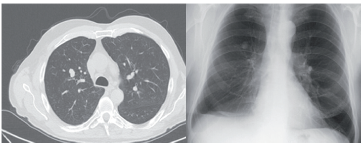 Zadopřední skiagram hrudníku a PET/CT řez s metabolicky aktivním
infiltrátem velikosti 12 mm v segmentu 3 pravé plíce