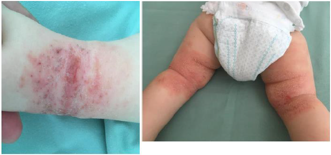 Ložiska atopické dermatitidy u 9měsíčního kojence před zahájením léčby