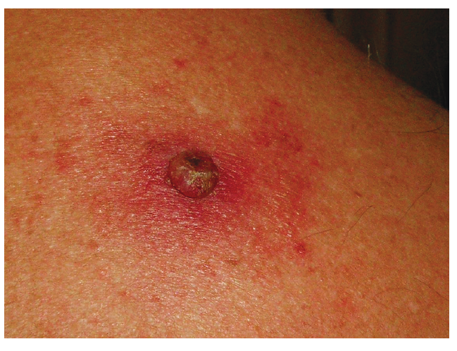 Primární melanom
(zdroj: Dermatovenerologická klinika VFN)